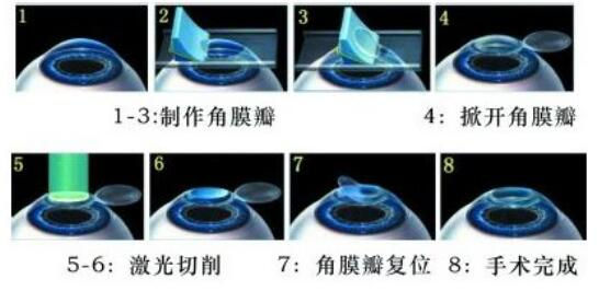準(zhǔn)分子激光手術(shù)到底是怎么治 愈你的眼睛的？