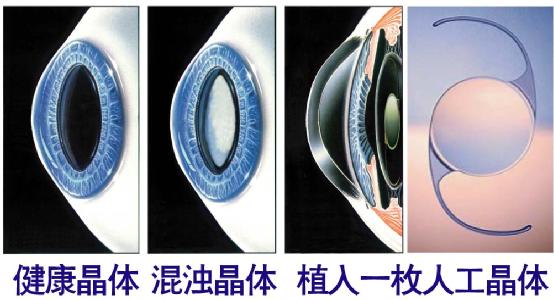 超聲乳化手術(shù)白內(nèi)障危險嗎？