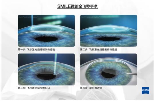 有近視，全飛秒激光手術(shù)后視力更好