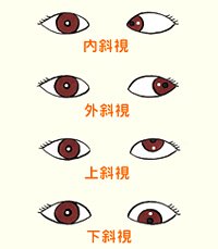 看看兒童斜視眼病怎么預(yù)防？