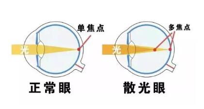 近視和散光，手術(shù)能同時(shí)矯正嗎？